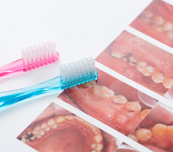 歯を守るために――歯周病を進行させないための大切なお話